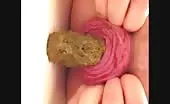 Anal prolapse while shitting
