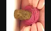 Real anal prolapse