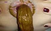 Ass prolapse while pooping