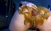 Anal prolapse after rough masturbation
